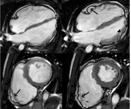 myocardial replacement of RV after Gadolinium Mild decrease of