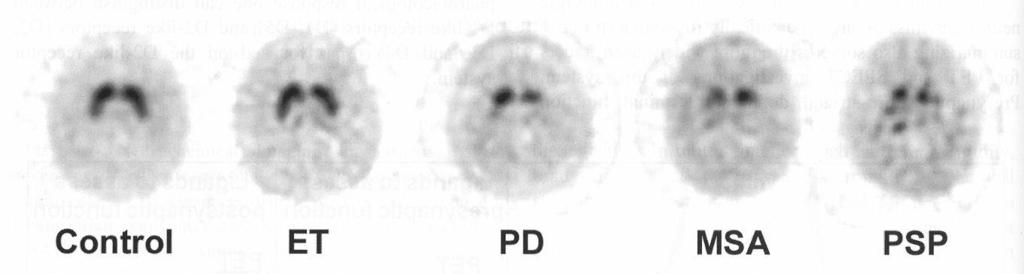 ΣΥΜΠΕΡΑΣΜΑΤΙΚΑ: Όλες οι νευροεκφυλιστικές νόσοι (νόσος Parkinson και Parkinson-plus σύνδρομα [PSP, MSA, LBD, CBGD]) δίνουν παθολογική σπινθηρογραφική εικόνα