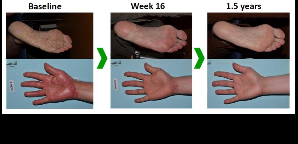 Σο Secukinumab επιτυγχάνει