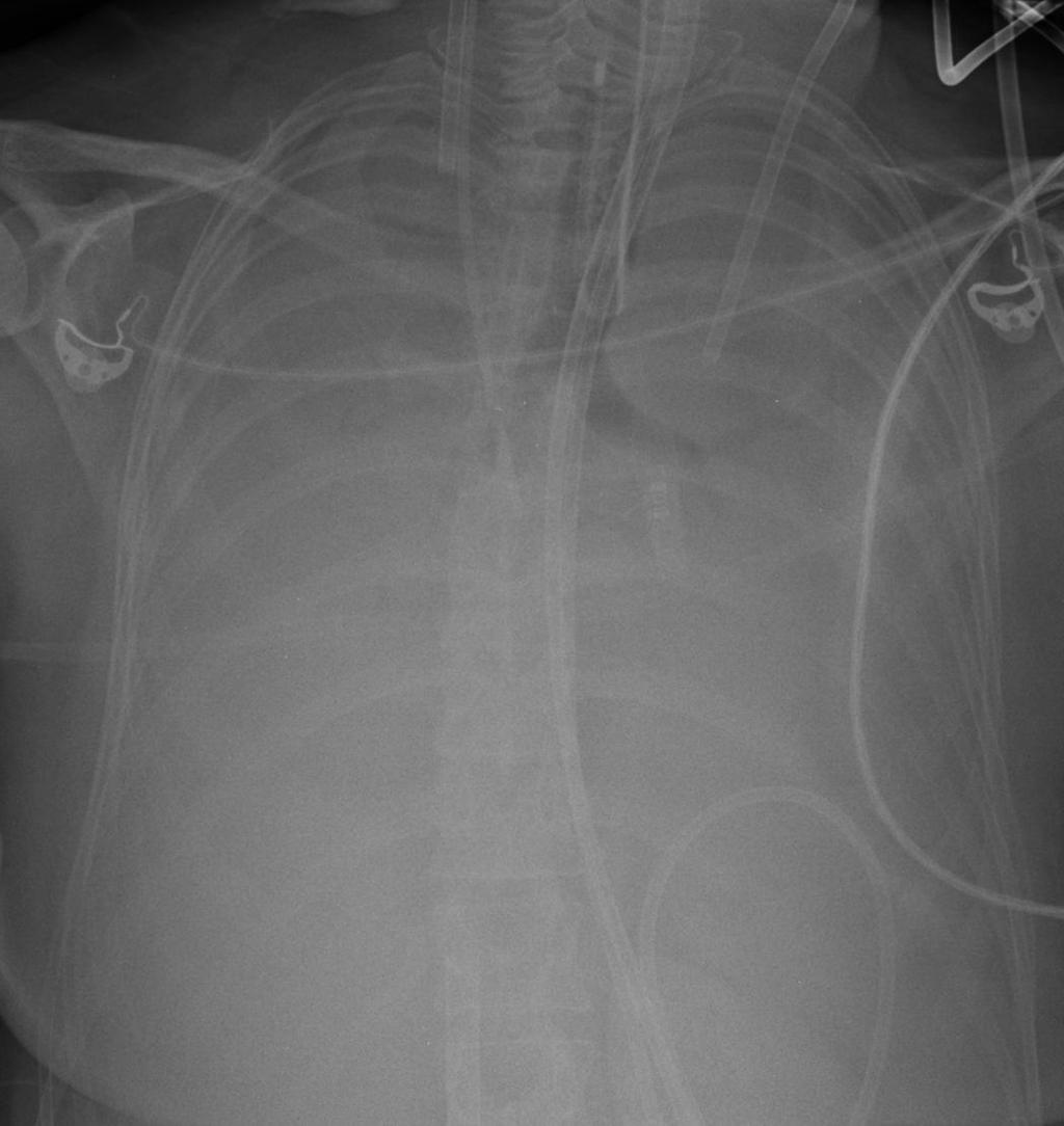 Extracorporeal Membrane Oxygenation &