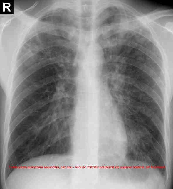 Leziunile caracteristice din punct de vedere radiologic sunt infiltratul şi caverna.