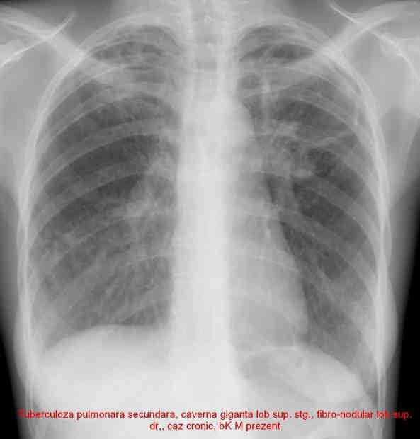 Infiltrat nodular poliulcerat lob sup. bilateral, bk pozitiv microscopie, caz nou Figura 21. TBC pulmonar secundar cavitar lob sup. dr. cu diseminări nodulare stg.