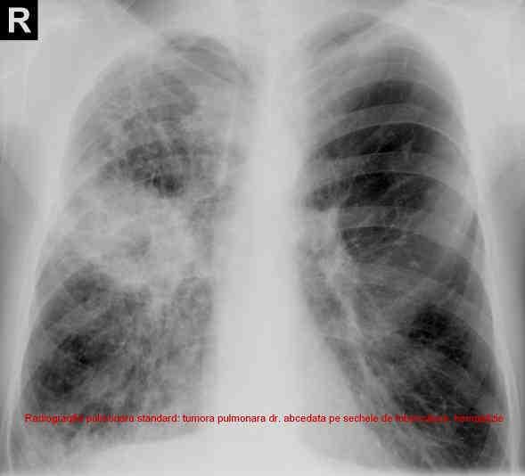 Totuşi, multe studii epidemiologice au găsit o creştere a riscului de cancer la bolnavii cu tuberculoză. Figura 24.