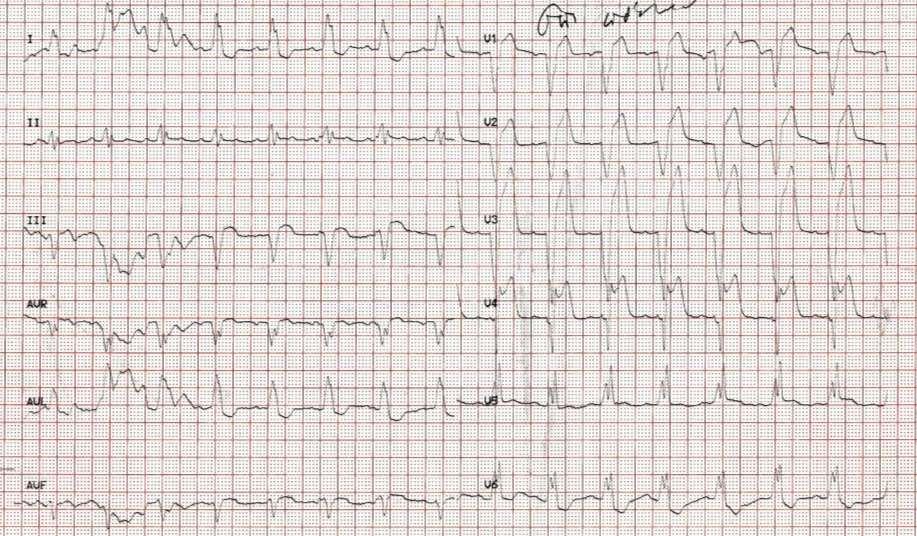 Ασθενής με γνωστό LBBB