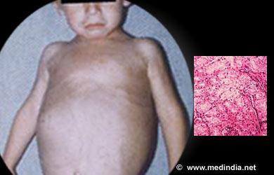 excepţia tip IV- speranţa de viaţă până la 5 ani) Diagnostic: Glucagonul i.m.