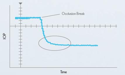 STABLE CHAMBER Ελάχιστο έως καθόλου surge μετά το occlusion break Το πατενταρισμένο Stable Chamber