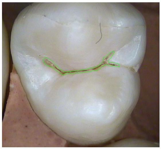 Κωδικός 1: λείες οδοντικές επιφάνειες Όταν η οδοντική επιφάνεια είναι υγρή δεν παρατηρείται αλλαγή του χρώματος που να αποδίδεται σε τερηδονική προσβολή, αλλά μετά από παρατεταμένο