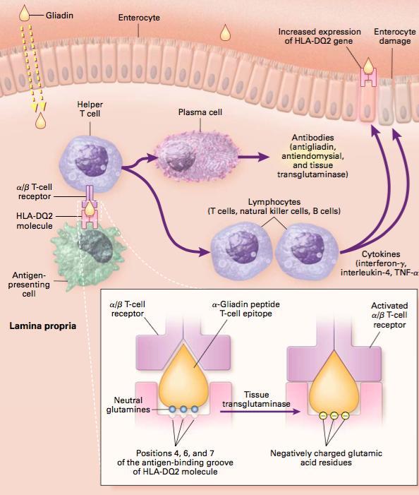 BOALA CELIACĂ Sdr de malabsorbție din boala celiacă: Gliadina (proteină din grâu, orz, secară) se fixează pe HLADQ2 a macrofagul (celula prezentatoare de antigen).