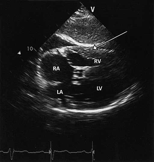 Εκτίμηση με M-mode ηχωκαρδιογραφία Το πάχος του τοιχώματος της RV μετράται στην κορυφή του κύματος R στο ηλεκτροκαρδιογράφημα, στο επίπεδο των χορδών της TV στην υποξιφοειδική τομή (φυσιολογική τιμή