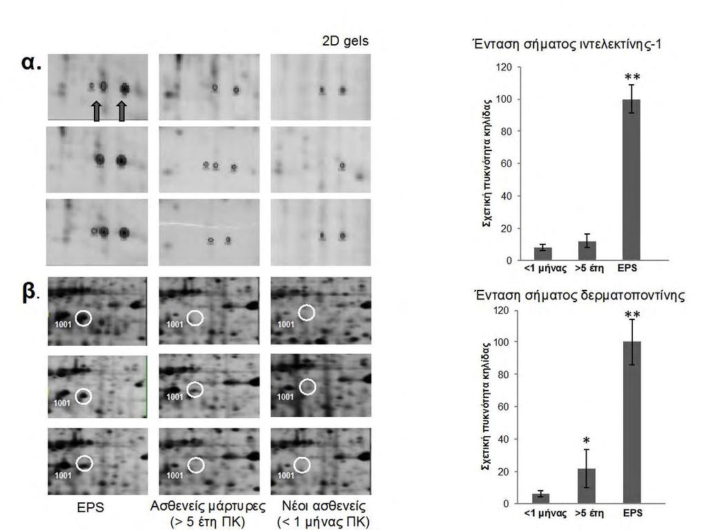 Εικόνα 29: Σε περιτοναϊκό διάλυμα που έχει υποστεί επεξεργασία με το σύστημα Proteominer, oι πρωτεϊνες ιντελεκτίνη-1 (α) και δερματοποντίνη (β) βρίσκονται αυξημένες σε ασθενείς με σκληρυντική