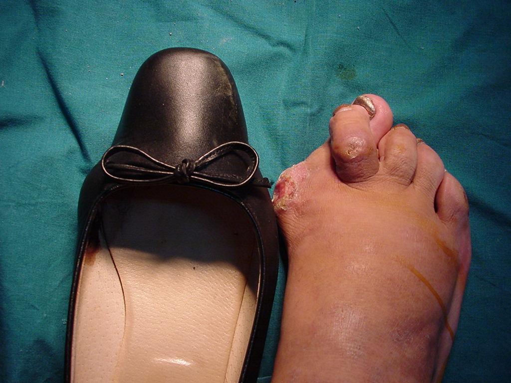 Ertapenem Patient 55 year old female (2) History of Diabetes for 17 years Purulent wound drainage Bilateral sensory loss on feet Foot deformity (HAV) Ill-fitting footwear Bilateral palpable pulses