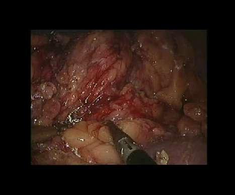 pancreasului Rinichiul stâng