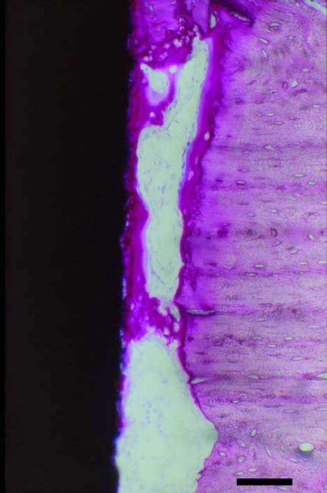 Εικόνα 19 : Εµφύτευµα αλουµινίου, 14 ηµέρες µετά την εµφύτευση. Εικόνα φωτεινού µικροσκοπίου 212.