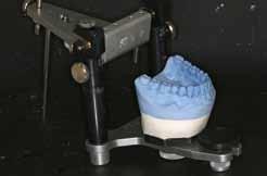 3 Κατασκευαστική Φάση Προσθετικής Αποκατάστασης Α) Αξιολόγηση οδοντικών επαφών μέγιστης οδοντικής συναρμογής, για την ανάρτηση στη θέση Μέγιστης Συγγόμφωσης Β) Προετοιμασία των οδοντικών φραγμών με