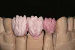 Η δόμηση της διαφάνειας (incisal, enamel porcelain), που οπτικά αναπαριστά την αδαμαντίνη, δίνει την τελική μορφολογία στο δόντι.