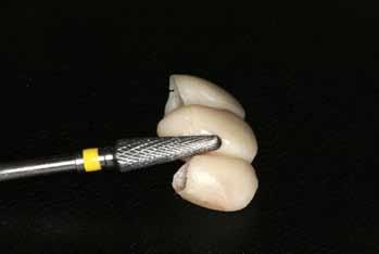 2 Μεταβατική Φάση Προσθετικής Αποκατάστασης απομάκρυνση της οδοντικής πλάκας από την ευαίσθητη περιοχή της ουλοδοντικής σχισμής (εικ. 8.11). Εικόνα 8.