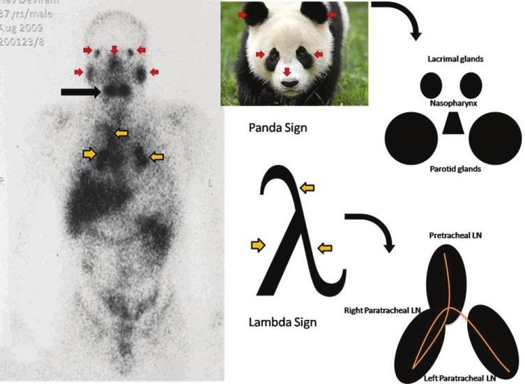 Some features can be suggestive of the disease such as the so-called panda sign or lambda sign, it is however