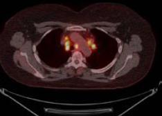 examination of cardiac and extra-cs, FDG PET imaging is the modality of