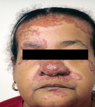 Cutaneous Involvement Although not life-threatening, but can be emotionally devastating and are divided into two categories: specific and nonspecific. Erythema nodosum may occur.