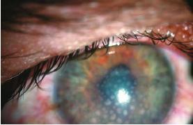 Ophthalmologic Complications The eye and adnexa are involved in 25-80% Anterior or posterior granulomatous uveitis, Optic neuritis.