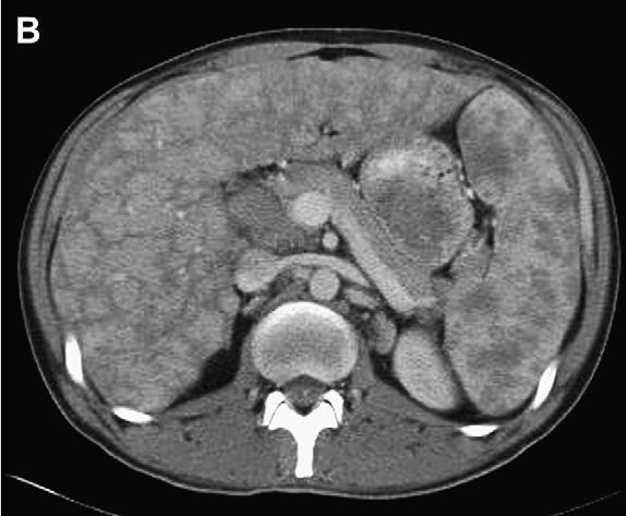 Liver and Spleen Involvement 10% of all patients with sarcoidosis have elevated serum aminotransferase and alkaline phosphatase levels.