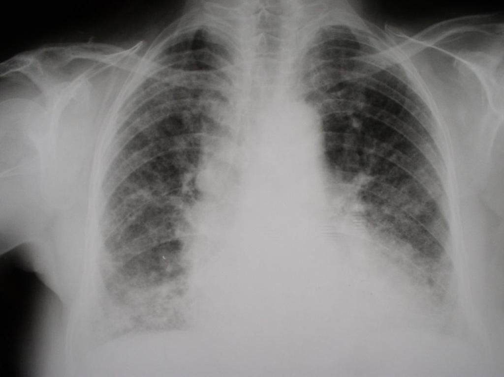 Idiopathic pulmonary fibrosis Clinical