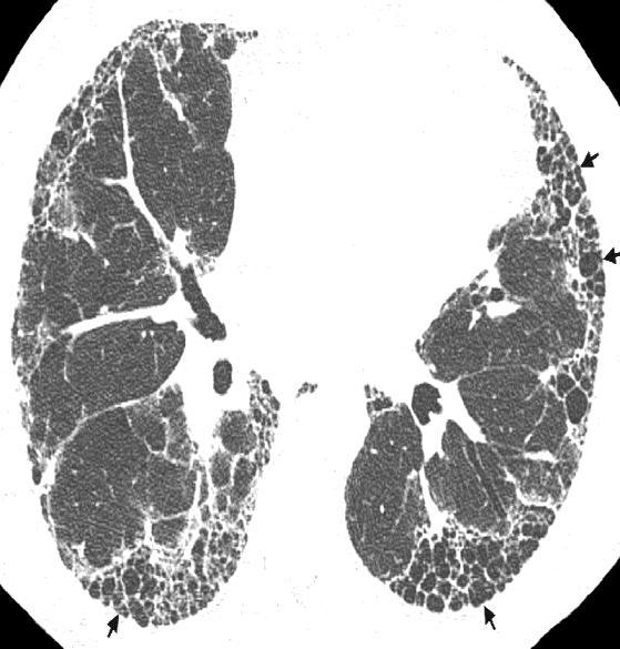 HRCT Images: UIP Pattern