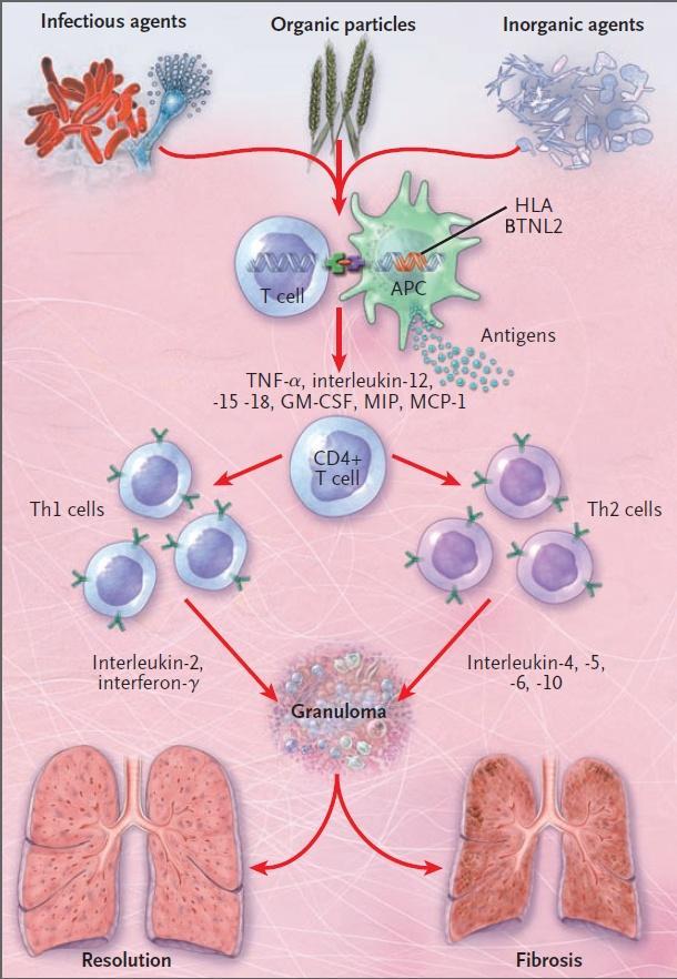 IMMUNOPATHOGENESIS The interaction between antigenpresenting cells (APCs) expressing HLA class II molecules and CD4+ T