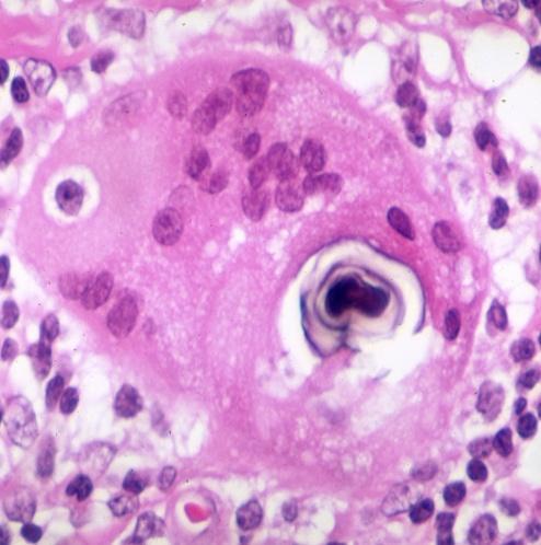 Typically, there is no necrosis within the sarcoid granuloma; however, on occasion, there is a small to moderate