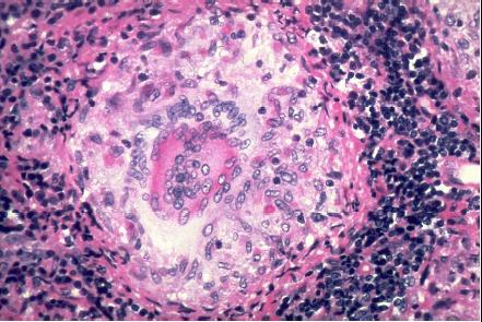 These granulomas are typically surrounded by lymphocytes in the periphery.