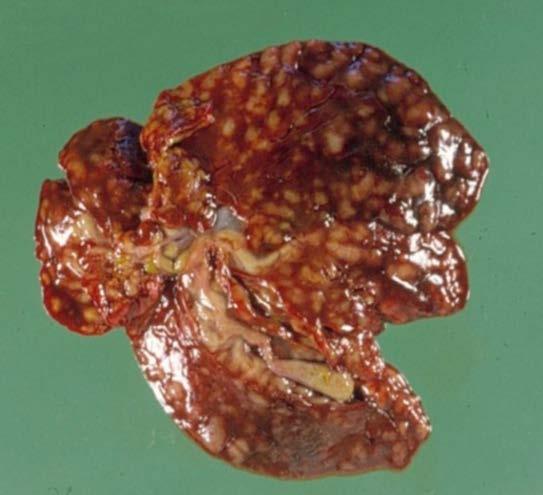 Figura 3/2: Mëlçi e shëndoshë (lart) me defekte të lindura me kanale të tëmthit të dubluar dhe mëlçi e prekur nga kokci-dioza (poshtë).