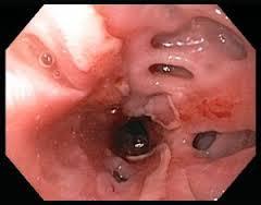 Hemorragjia e traktit të poshtëm gastrointestinal. Hemorragjia e traktit të poshtëm gastrointestinal ndodhin më rralle në krahesim me hemorragjin në traktin e sipërm gastrointestinal.