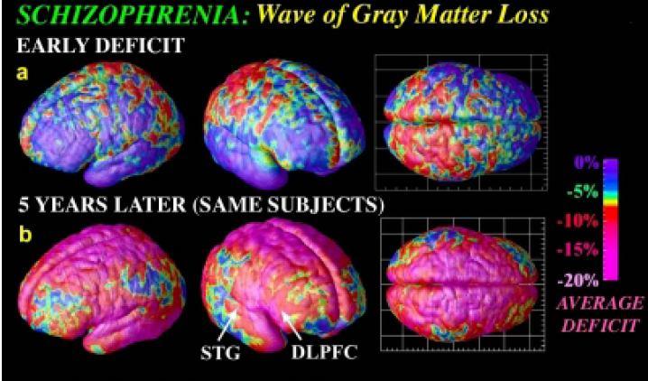 оболео а други здрав. У скоро свим паровима, близанац који је оболео од схизофреније има веће бочне коморе и мању величину кортекса и хипокампуса (12