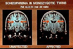 Слика 3. Повећање латералних комора код монозиготног близанца оболелог од схизофреније (десно) у односу на здравог (лево) (адаптирано по Noga et al.