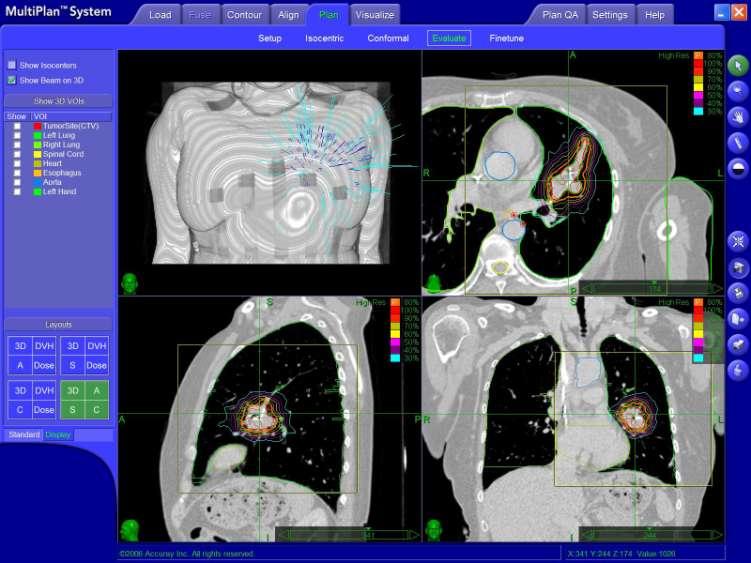 NSCLC μετά από