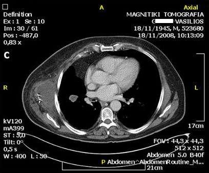 NSCLC μετά από