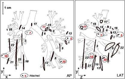 Lung tumor motion varies widely (0 50 mm) Lung: hysteresis in half of the patients (1 to 5 mm separation of trajectories) Abdominal (liver, kidney, diaphragm) 35 101 mm (deep breathing) Motion