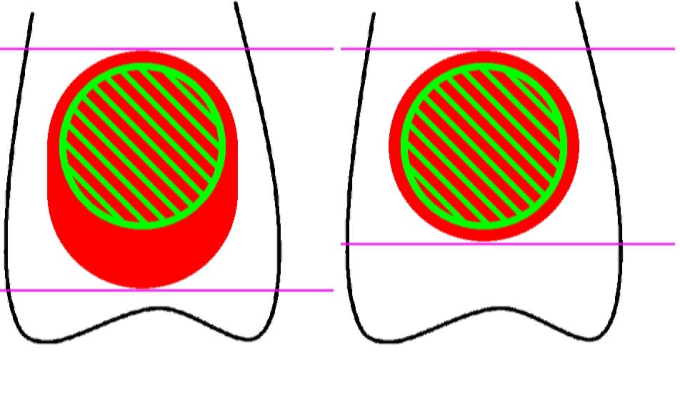 Image Guided Radiation Therapy (IGRT) vs