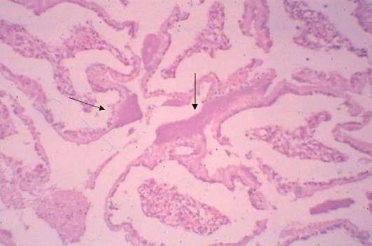 1. Colibaciloza Enteritele bacteriene - produsă de Escherichia