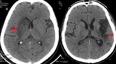 1.8.2. Неурорадиолошка дијагностика У дијагностиковању лезије АИМУ неопходна је визуализација мозга компјутеризованом томографијом (КT) или магнетном резонанцом (MР).