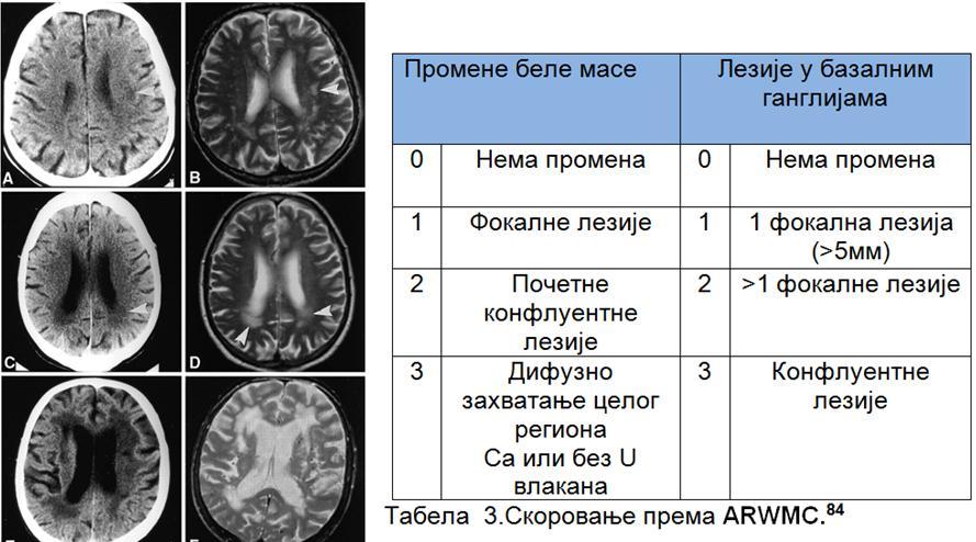 Преглед беле масе мозга Неурорадиолошки преглед обухвата и преглед беле масе. Он се може обавити помоћу КТ или МР.