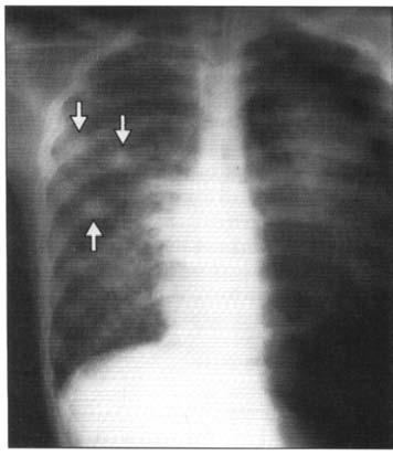 Spiroski M i sorabotnici. ANALIZA NA SLU^AI OD IMUNOLOGIJA Slika 1.