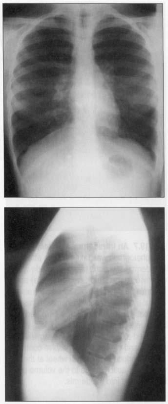 Filipovite problemi so di{eweto bile lekuvani kako {to treba so bronhodilatatori (pro{iruva~i na bronhiite) kako {to se teofilin i/ili vdi{uvawe albuterol.