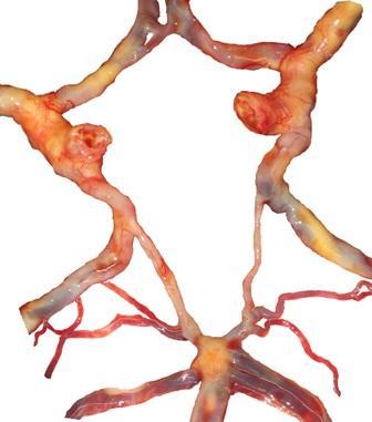 приказаног случаја, забележене су транзиторне артеријске анастомозе у нивоу предњег и у нивоу задњег сегмента CAC.