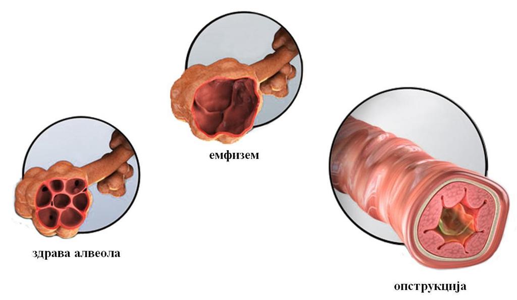 Слика 2. Дисајни путеви Конзумирање дувана је један од најчешћих узрочника настанка ХОБП-а, али неће све особе са сличним пушачким стажом оболети од ове болести.