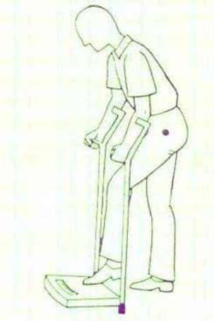 Слика 16. Мерење на оптоварувањето на оперираниот екстремитет Figure 16. Measurement the load on the operated limb Постои разлика во оптоварувањето кај без цементната и цементната ендопротеза.