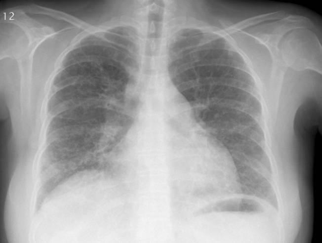 Pulmonaalne arteriaalne hüpertensioon süsteemse skleroosi puhul 37-aastane naispatsient süsteemse skleroosiga, tüsistuseks raske PAH.