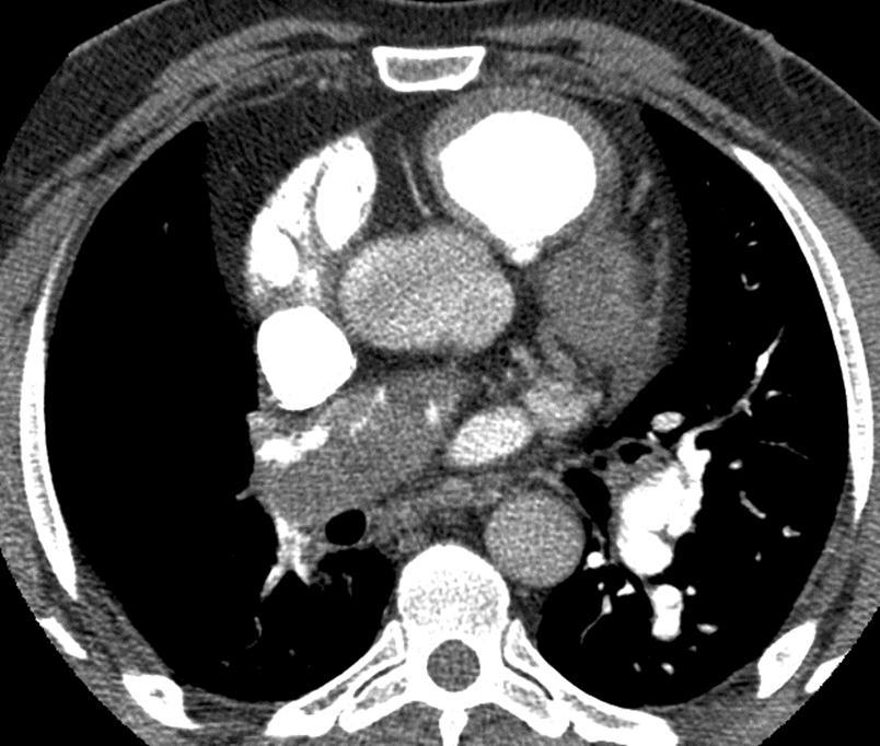 CTEPH CT uuringul Bronhiaalarteri (keharingest) süsteemist