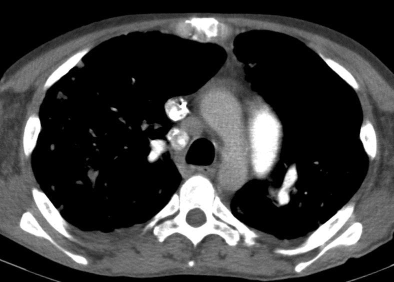 Pulmonaalhüpertensiooni tunnused CT