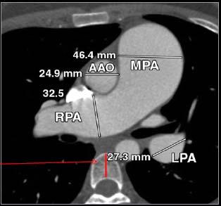 Pulmonaalhüpertensiooni tunnused CT uuringul PA/Aordi läbimõõtude suhe >1 isikutel <50 a.